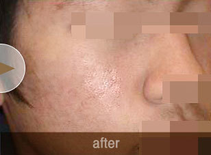 SR-acne 레이저 시술 전후
