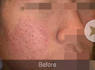 SR-acne 레이저 시술 전후